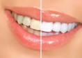 Protecção Dentária